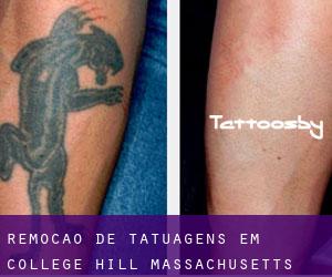 Remoção de tatuagens em College Hill (Massachusetts)