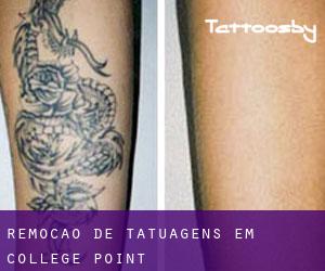 Remoção de tatuagens em College Point