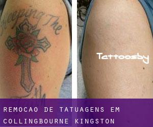 Remoção de tatuagens em Collingbourne Kingston