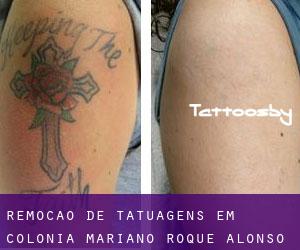 Remoção de tatuagens em Colonia Mariano Roque Alonso