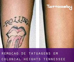 Remoção de tatuagens em Colonial Heights (Tennessee)