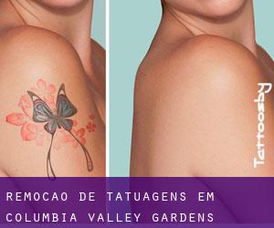 Remoção de tatuagens em Columbia Valley Gardens