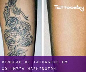 Remoção de tatuagens em Columbia (Washington)