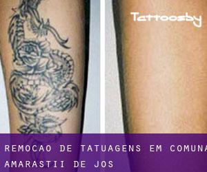 Remoção de tatuagens em Comuna Amărăştii de Jos