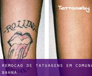 Remoção de tatuagens em Comuna Bahna