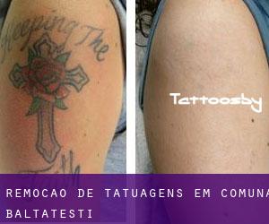 Remoção de tatuagens em Comuna Bălţăteşti