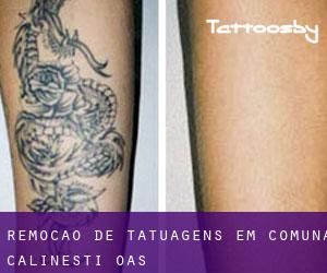 Remoção de tatuagens em Comuna Cãlineşti-Oaş
