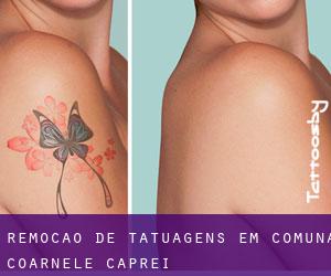 Remoção de tatuagens em Comuna Coarnele Caprei