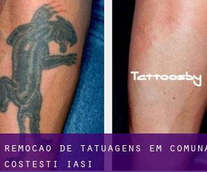 Remoção de tatuagens em Comuna Costeşti (Iaşi)