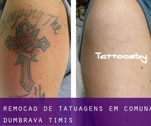 Remoção de tatuagens em Comuna Dumbrava (Timiş)