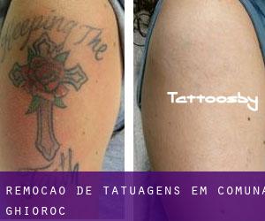 Remoção de tatuagens em Comuna Ghioroc