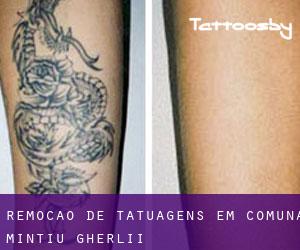 Remoção de tatuagens em Comuna Mintiu Gherlii