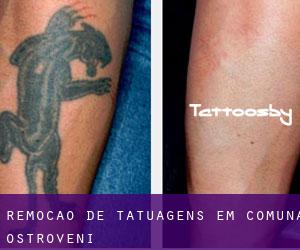 Remoção de tatuagens em Comuna Ostroveni