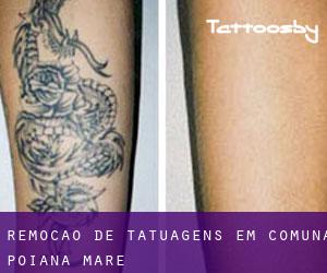 Remoção de tatuagens em Comuna Poiana Mare