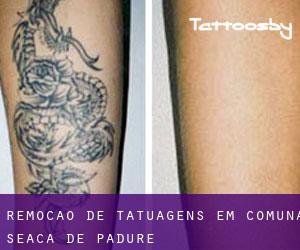 Remoção de tatuagens em Comuna Seaca de Pădure