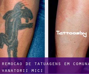 Remoção de tatuagens em Comuna Vânătorii Mici