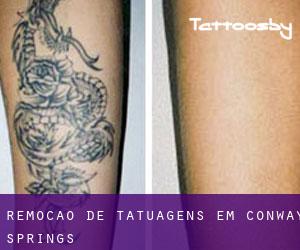 Remoção de tatuagens em Conway Springs