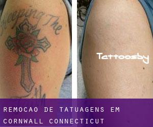 Remoção de tatuagens em Cornwall (Connecticut)