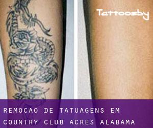 Remoção de tatuagens em Country Club Acres (Alabama)