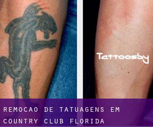 Remoção de tatuagens em Country Club (Florida)