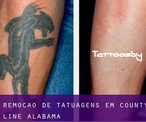 Remoção de tatuagens em County Line (Alabama)