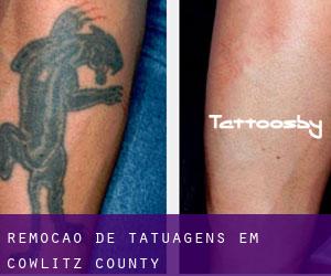 Remoção de tatuagens em Cowlitz County
