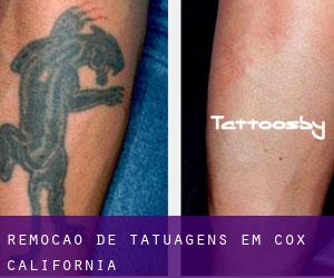 Remoção de tatuagens em Cox (California)