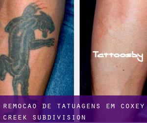 Remoção de tatuagens em Coxey Creek Subdivision