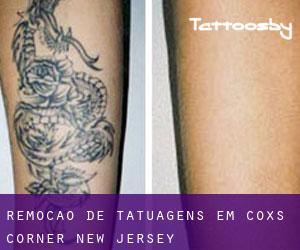Remoção de tatuagens em Coxs Corner (New Jersey)