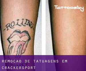 Remoção de tatuagens em Crackersport