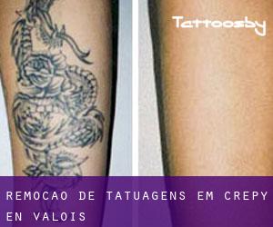 Remoção de tatuagens em Crépy-en-Valois