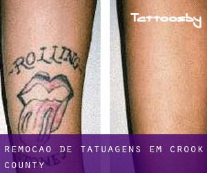 Remoção de tatuagens em Crook County