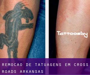 Remoção de tatuagens em Cross Roads (Arkansas)