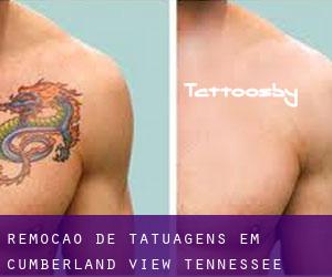 Remoção de tatuagens em Cumberland View (Tennessee)