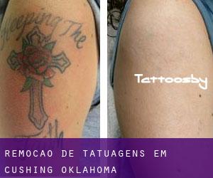 Remoção de tatuagens em Cushing (Oklahoma)
