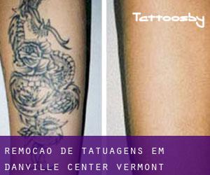 Remoção de tatuagens em Danville Center (Vermont)