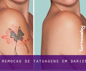 Remoção de tatuagens em Darién