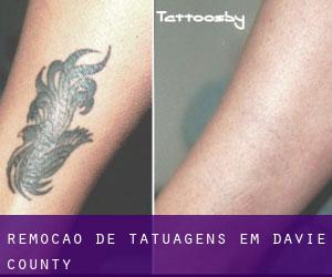 Remoção de tatuagens em Davie County