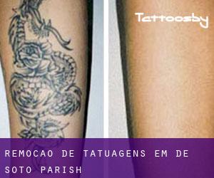 Remoção de tatuagens em De Soto Parish
