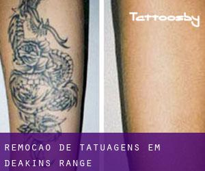 Remoção de tatuagens em Deakins Range