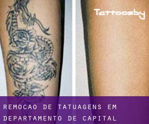 Remoção de tatuagens em Departamento de Capital