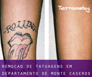 Remoção de tatuagens em Departamento de Monte Caseros