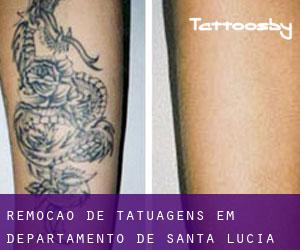 Remoção de tatuagens em Departamento de Santa Lucía