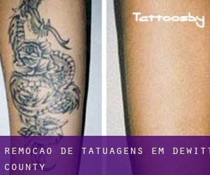 Remoção de tatuagens em DeWitt County
