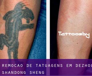 Remoção de tatuagens em Dezhou (Shandong Sheng)