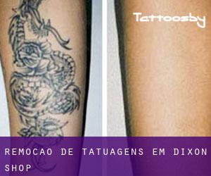 Remoção de tatuagens em Dixon Shop