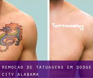 Remoção de tatuagens em Dodge City (Alabama)