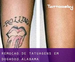 Remoção de tatuagens em Dogwood (Alabama)