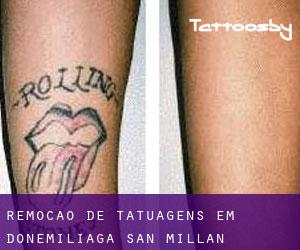 Remoção de tatuagens em Donemiliaga / San Millán