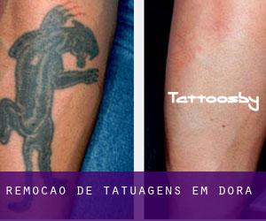 Remoção de tatuagens em Dora